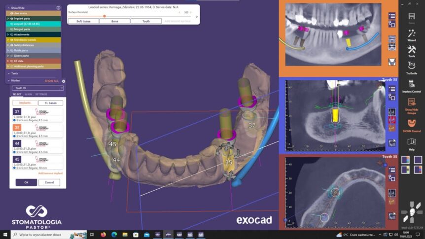 NEW guided surgery case solved with the DAS Guided Surgical Kit